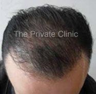 FUE hair transplantation