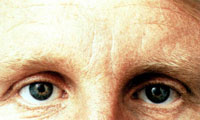 Glabellar frown lines after treatment with Restylane injections.