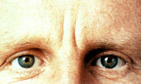 Glabellar frown lines before treatment with Restylane injections.