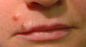 Intradermal Nevi on the Lip - Before