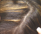 Female hair after laser hair loss therapy