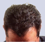 Male front of hair after laser hair loss therapy