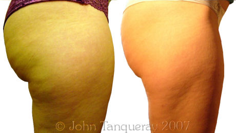 Laser Lipolysis Treatment on the inner and outer thighs