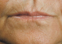 Thin lips and lip lines lines before treatment with Restylane®