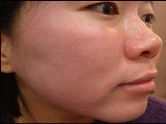 Acne After Treatment with MTS Roller