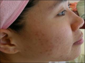 Acne Before Treatment