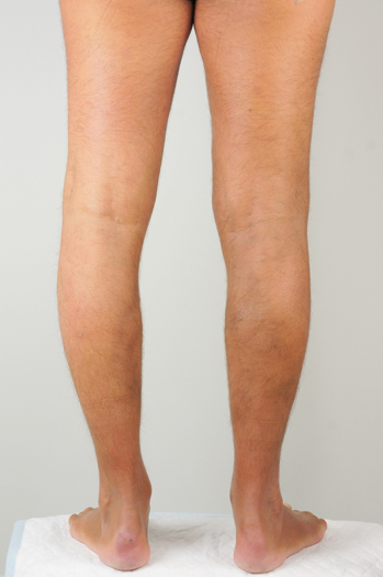 Males legs after having Varicose Veins removed with Endovenous Laser Ablation treatment