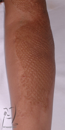 Mesh skin graft scarring