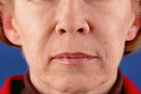 Nasolabial lines after treatment with Restylane®