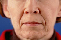 Nasolabial lines before treatment with Restylane®