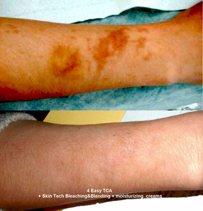 hyperpigmentation on an arm before and after Easypeel