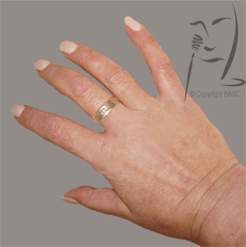 Hand with psoriasis after skin camouflage application