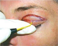 Radiosurgery Blepharoplasty