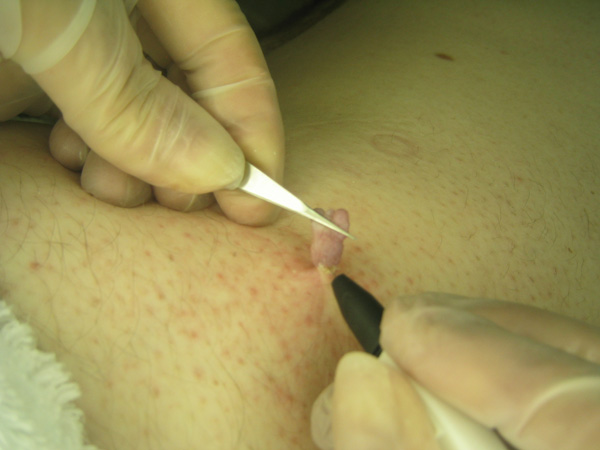 Skin Tag Treatment Using Electrolysis - Step 2