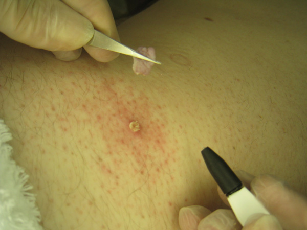 Skin Tag Treatment Using Electrolysis - Step 3