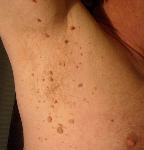 Skin Tags