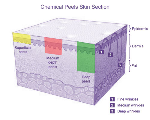 Chemical Peel Strength Chart