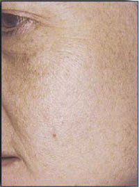 After a course of 3 IPL treatments.