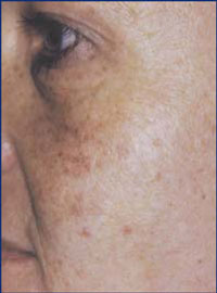 Female with sun damage.