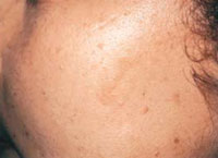 Patient 2 months after 2 IPL treatments.