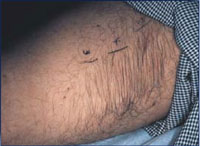 Female with hair on the thigh before treatment.
