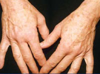 Reduction in age spots following 1 IPL treatment.