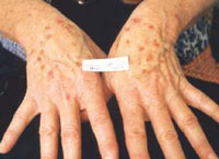 Female with age spots on the hands (sun induced freckles) before treatment.