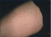 Reduction in thigh hair 1 year after final IPL treatment