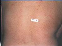 Reduction in back hair after 2 years following a course of 4 IPL treatments.