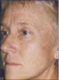 After a course of 3 IPL treatments.