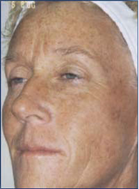 Female with sun damage before treatment.