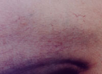 Improvement in leg thread veins following a course of microsclerotherapy treatment.