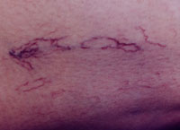 Leg thread veins before microslerotherapy treatment.