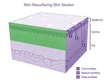 Laser Skin Resurfacing