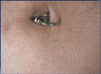 Reduction in abdomen hair following a course of 3 IPL treatments over 2 months