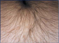 Female with hair on the abdomen before treatment.