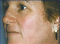 Patient after 3 IPL treatments.