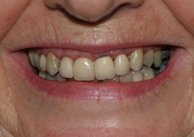 Teeth Cosmetic Correction (Fillings, Bonding, Crowns & Bridges) Information