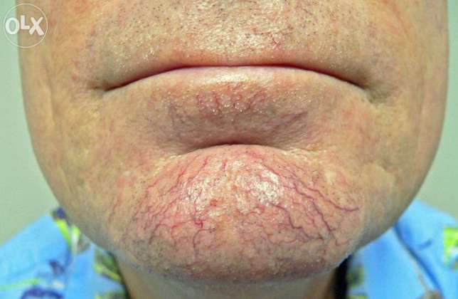 Chin thread veins before Thermavein treatment