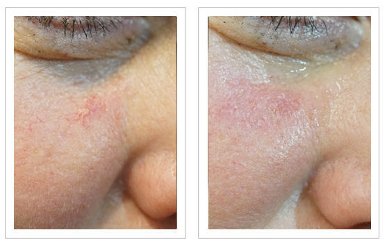 Before and after Thermavein treatment on cheek