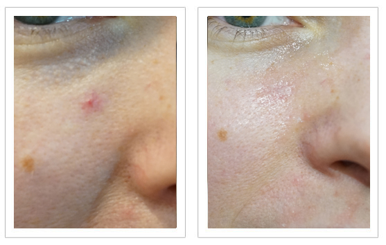 Before and after Thermavein treatment for red spot