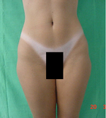 Smart Lipo - Outer Thighs After Treatment