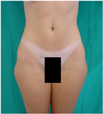 Smart Lipo - Outer Thighs Before Treatment