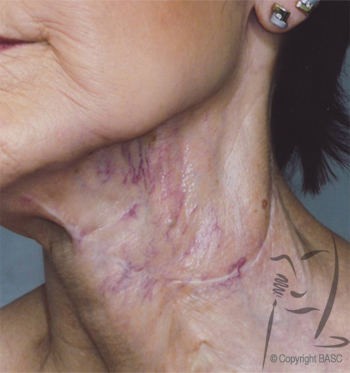 Vascular disturbance on female neck