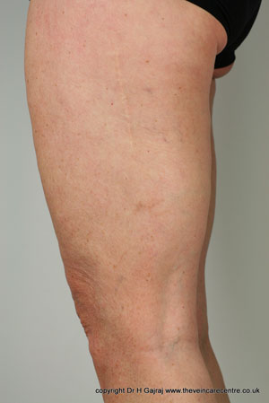 After sclerotherapy treatment