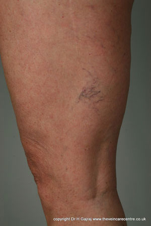 Legs veins before sclerotherapy treatment