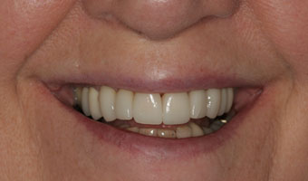 Close-up After Treatment with Cosmetic Veneers