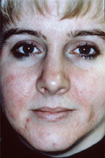 Acne before microdermabrasion treatment