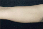 Smart Lipo - Upper Arm After Treatment