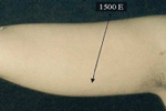 Smart Lipo - Upper Arm Before Treatment